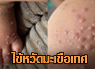 โรคใหม่!! “อนุทิน” สั่งเฝ้าระวังไข้หวัดมะเขือเทศ เตรียมแนวทางคัดกรอง