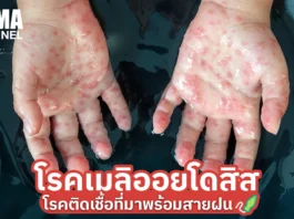 รัฐบาลเตือนเฝ้าระวัง “โรคเมลิออยด์โดสิส” พบผู้ป่วยสะสม 732 ราย เสียชีวิต 23 ราย